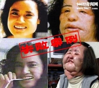 ​世界上最失败的整容者，韩苗可整容上瘾注射食用油