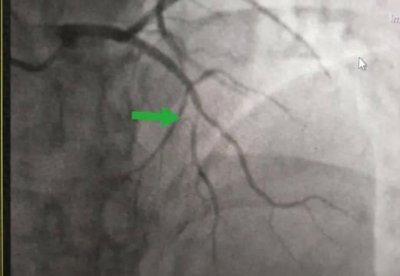 ​做完冠脉造影，病人就活不久了？医生劝告：4种人别轻易尝试